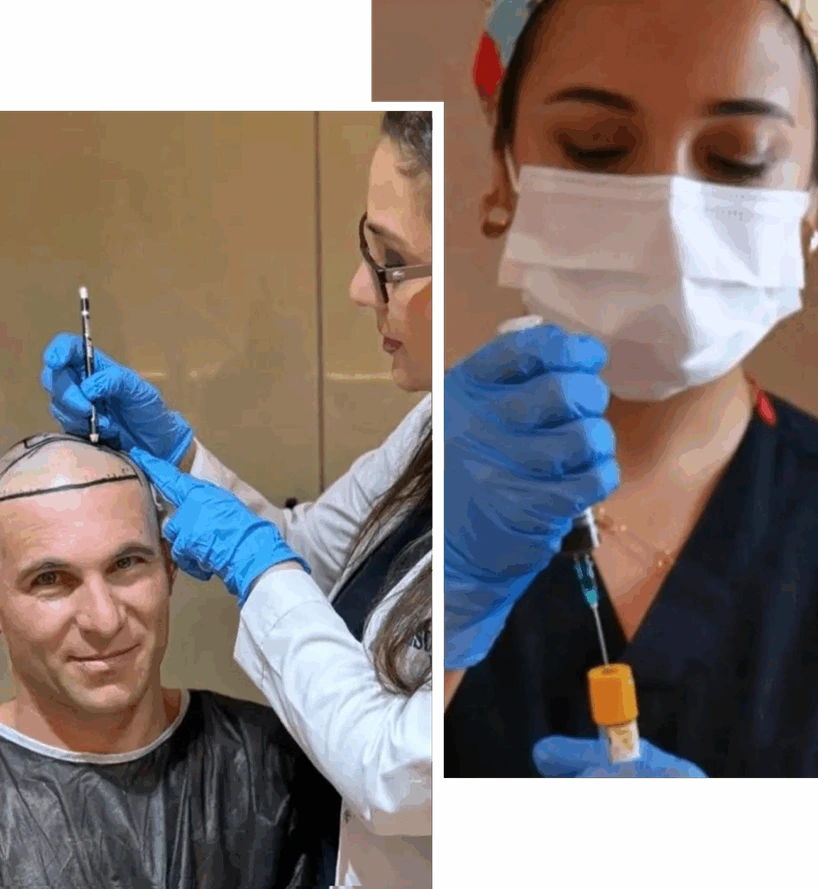 As imagens retratam partes do processo do tratamento de transplante capilar, a primeira imagem retrata um homem sem cabelos tendo sua cabeça desenhada e medida e a segunda imagem retrata uma profissional segurando uma seringa. Essa imagem representa o ambiente profissional e cuidado com o paciente.