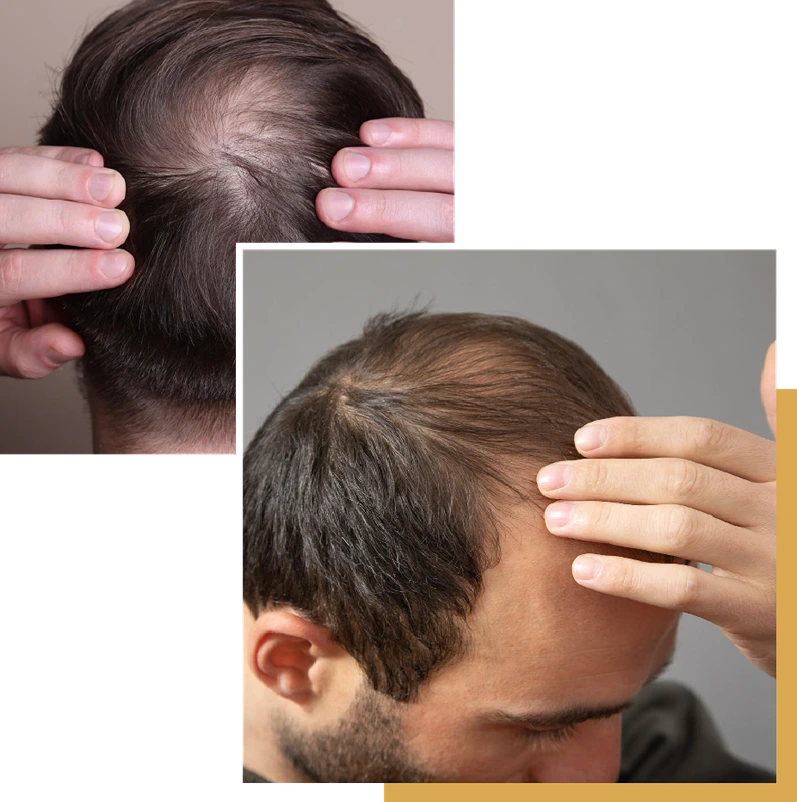 Dois homens com calvície tocando em seus cabelos finos com expressões melancólicas. Essa imagem representa o estado de muitos homens que buscam a ajuda da Rio Hair.